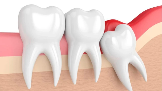 Răng khôn mọc ngang có nguy hiểm không? Nguyên nhân, biến chứng và cách xử lý