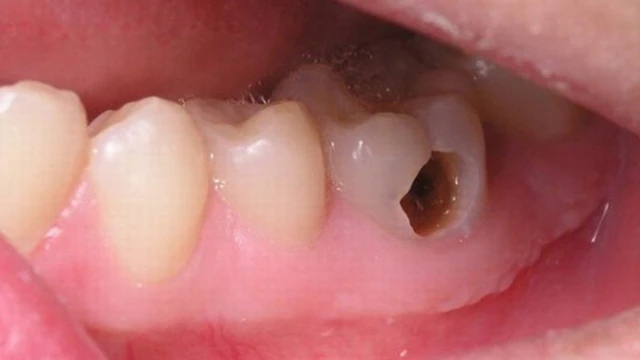 Răng sâu vào tủy là gì? Dấu hiệu và cách phòng ngừa hiệu quả