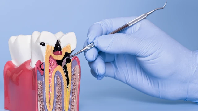 Răng số 7 bị sâu vỡ có nguy hiểm không? Điều trị và cách phòng ngừa