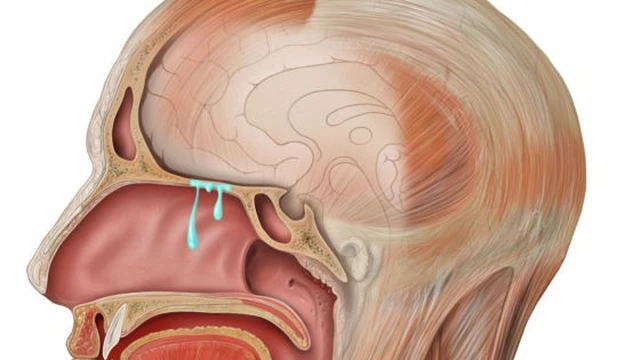 Rò dịch não tủy là gì? Nguyên nhân, chẩn đoán và điều trị