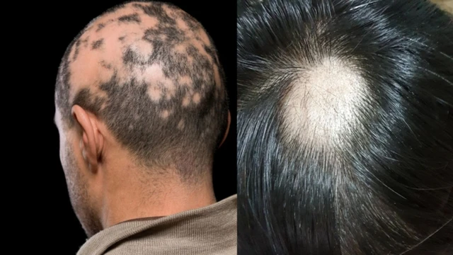 Rụng tóc từng mảng: Nguyên nhân, dấu hiệu và cách điều trị hiệu quả
