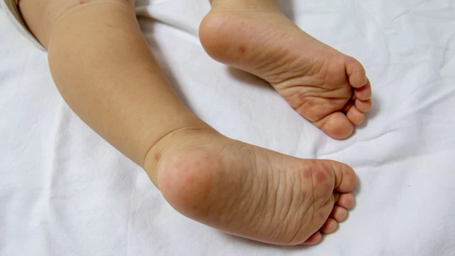 10 sai lầm khi chăm sóc trẻ bị tay chân miệng mà phụ huynh cần lưu ý