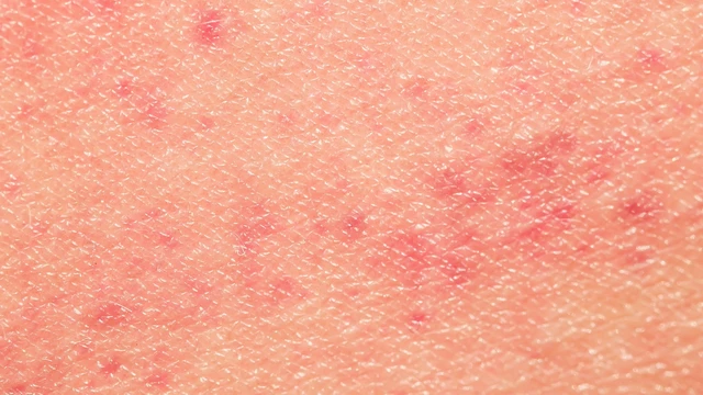 Sarcoma Kaposi là gì? Dấu hiệu nhận biết, đối tượng nguy cơ và hướng điều trị hiện nay