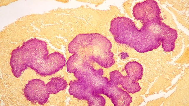 Sarcoma mô mềm: Nhận biết sớm dấu hiệu để tăng cơ hội điều trị thành công