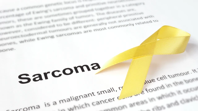 Sarcoma xơ bì lồi: Nhận biết dấu hiệu, nguyên nhân 