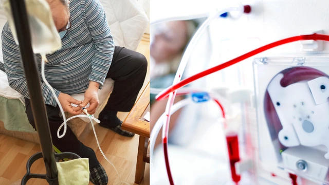 So sánh lọc màng bụng và chạy thận nhân tạo: Hiểu rõ để chọn đúng phương pháp điều trị suy thận