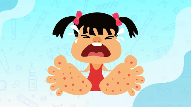 Sởi hay tay chân miệng? Đừng nhầm lẫn khi con sốt phát ban!