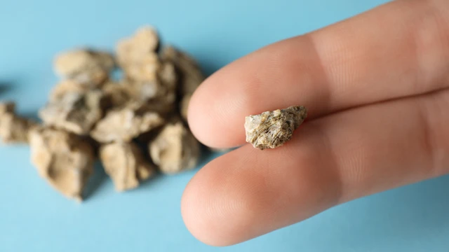 Sỏi thận 5mm là gì? Điều trị thế nào cho phù hợp?