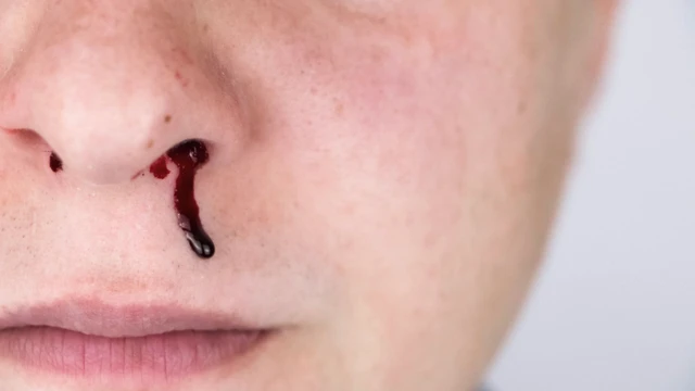 Sốt xuất huyết gây chảy máu cam có nguy hiểm không? Cách phòng ngừa