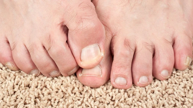 Vì sao sốt xuất huyết gây ngứa lòng bàn tay bàn chân?