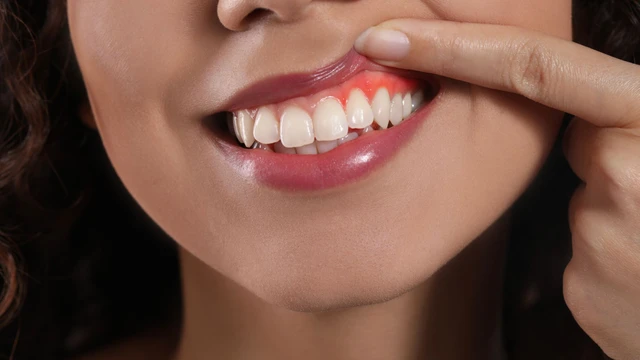 Sưng chân răng là gì? Nguyên nhân và dấu hiệu nhận biết