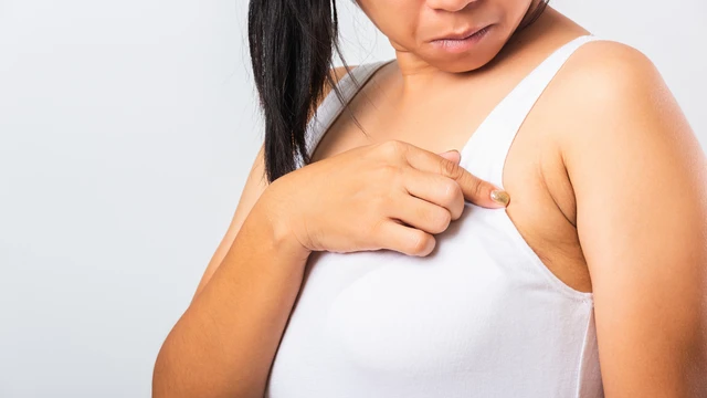 Sưng hạch bạch huyết ở nách: Nguyên nhân, cách xử lý và phòng ngừa