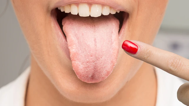 Tại sao bị nấm Candida tái đi tái lại? Cách phòng tránh tái phát nhiễm Candida