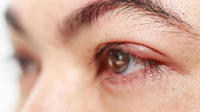 Tại sao lẹo mắt bị chai? Hướng dẫn chăm sóc đúng cách