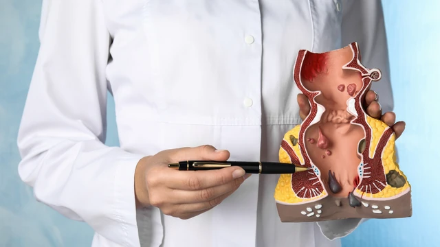 Tại sao phụ nữ thường bị trĩ sau sinh? Dấu hiệu nhận biết