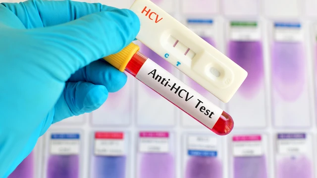 Xét nghiệm HCV Ab miễn dịch tự động: Ý nghĩa, tầm quan trọng trong sàng lọc viêm gan C