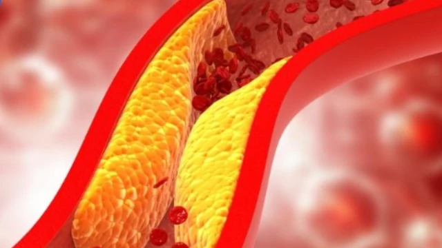 Tăng lipid máu do rối loạn chuyển hóa lipoprotein: Nguyên nhân và cách điều trị