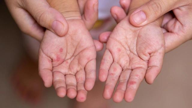 Tay chân miệng cấp độ 1 có lây không? Giải đáp và cách phòng ngừa