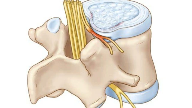 Thoái hóa đốt sống cổ chèn dây thần kinh: Dấu hiệu và cách điều trị