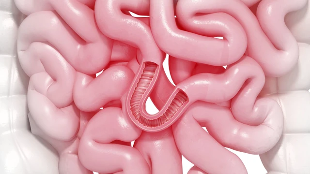 Thủng ruột là gì? Thủng ruột có nguy hiểm không?