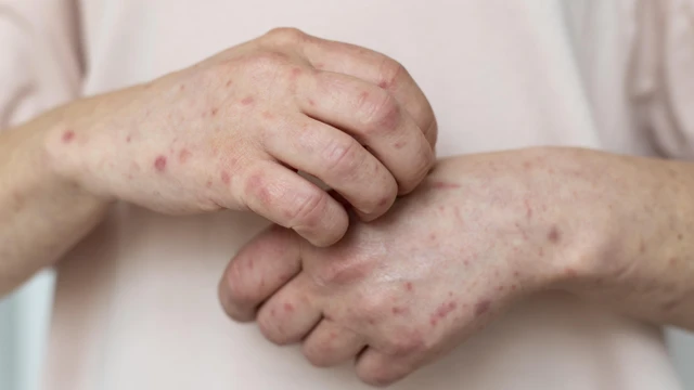 Thủy đậu bị mấy lần trong đời? Có thể mắc lại không?