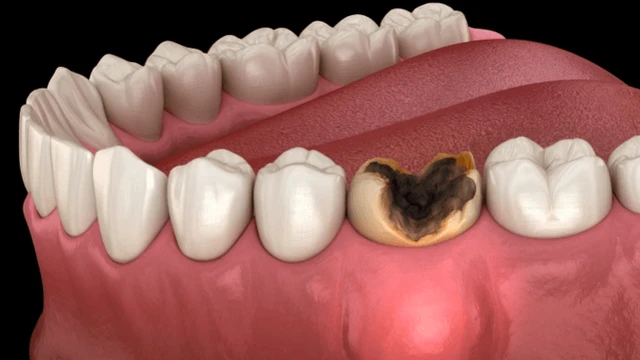 Răng chết tủy: Triệu chứng và phương pháp khắc phục