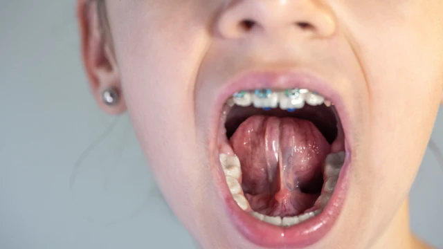 Tĩnh mạch dưới lưỡi màu đen hoặc tím: Khi nào là dấu hiệu đáng lo?