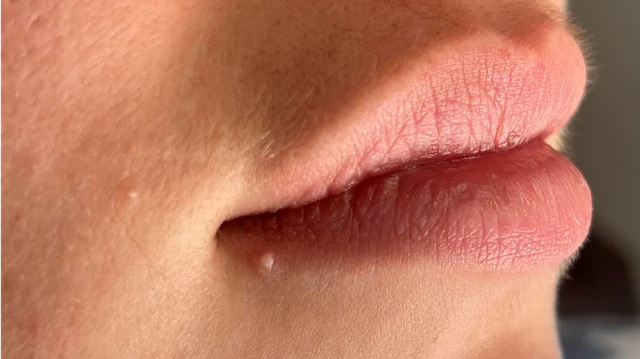Sùi mào gà ở môi: Nguyên nhân, dấu hiệu, cách điều trị