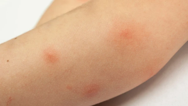 Trẻ bị muỗi đốt sưng to​ phải làm sao? Cách xử trí tại nhà