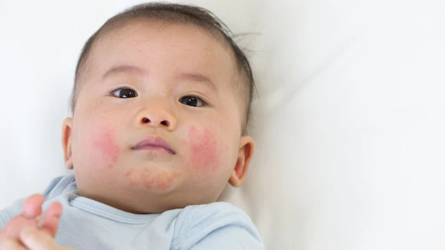 Trẻ bị phát ban sau sốt cần kiêng gì​? Cách nâng cao sức đề kháng ở trẻ 