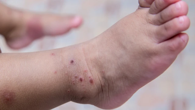 Trẻ bị tay chân miệng có cần uống Oresol? Giải đáp chi tiết cho cha mẹ