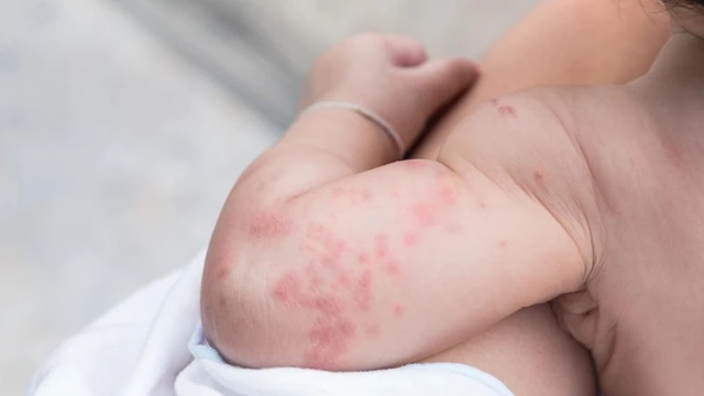 Trẻ sơ sinh bị giời leo có sao không? Dấu hiệu nhận biết và cách xử lý