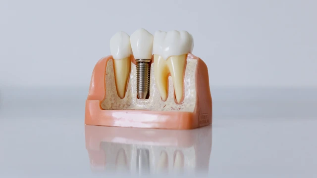 Trồng răng sứ giá bao nhiêu 1 chiếc? Trồng răng sứ có đau không?
