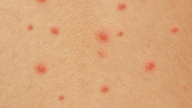 U mềm lây có tự khỏi không? Nguyên nhân, điều trị và phòng ngừa
