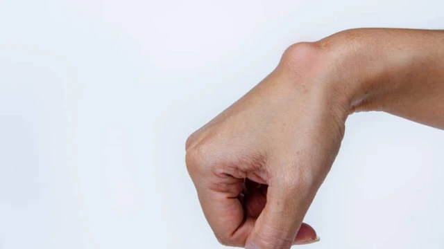 U mỡ dưới da: Nguyên nhân, dấu hiệu và cách điều trị hiệu quả