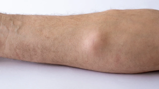 U mỡ ở cánh tay: Nguyên nhân, và cách điều trị hiệu quả