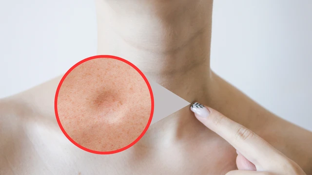 U mỡ ở cổ: Nguyên nhân, dấu hiệu và cách điều trị an toàn