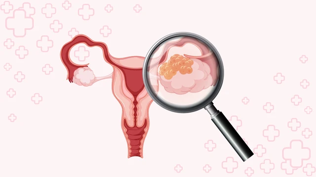 U nang bì buồng trứng là gì? Triệu chứng, nguyên nhân, chẩn đoán và điều trị