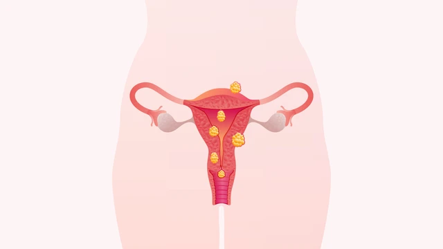 U nang buồng trứng là gì? Triệu chứng, nguyên nhân, chẩn đoán và điều trị