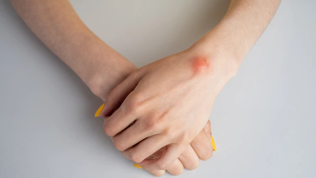 U nang lông là gì? Những thông tin quan trọng cần biết