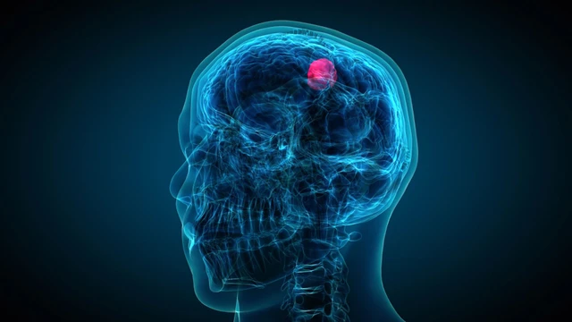 U não có di truyền không? Cách nhận biết nguy cơ