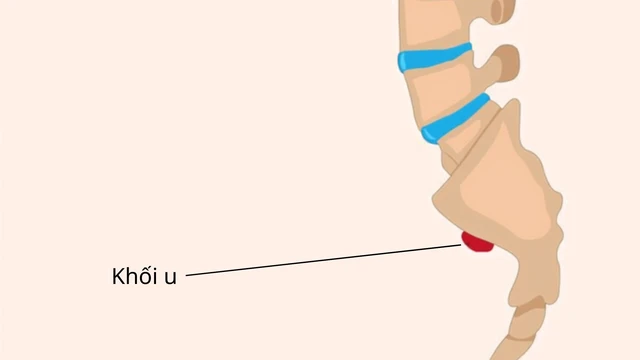 U nguyên sống là gì? Triệu chứng, nguyên nhân và cách điều trị