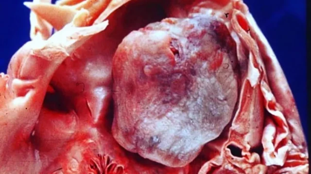 U nhầy nhĩ trái là gì? Triệu chứng, biến chứng và cách điều trị