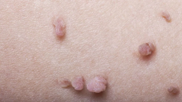 U nhú là gì? Nguyên nhân, triệu chứng và cách điều trị