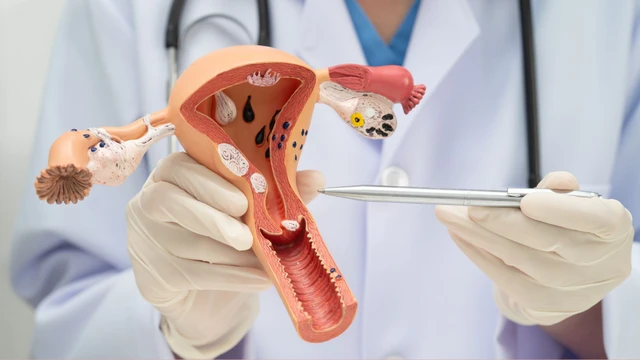 U xơ gây chảy máu: Nguyên nhân, dấu hiệu và cách điều trị