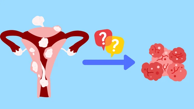 U xơ tử cung có chuyển thành ung thư không? Dấu hiệu cần cảnh giác