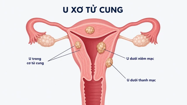 U xơ tử cung thoái hóa: Nguyên nhân, dấu hiệu và cách điều trị
