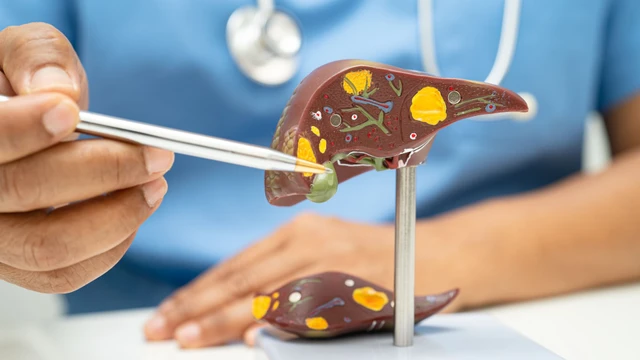 Ung thư gan giai đoạn 2: Triệu chứng, điều trị và cách phòng ngừa hiệu quả