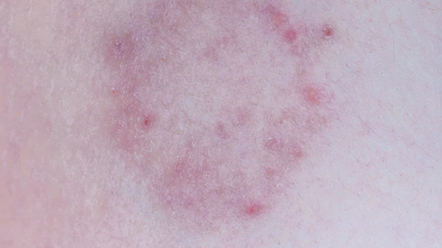 Vết tròn bị nổi đốm đỏ trên da không ngứa: Cảnh báo nguyên nhân ít người để ý