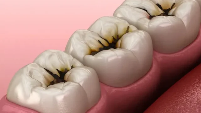 Vi khuẩn gây sâu răng có những loại nào? Cách phòng ngừa hiệu quả
